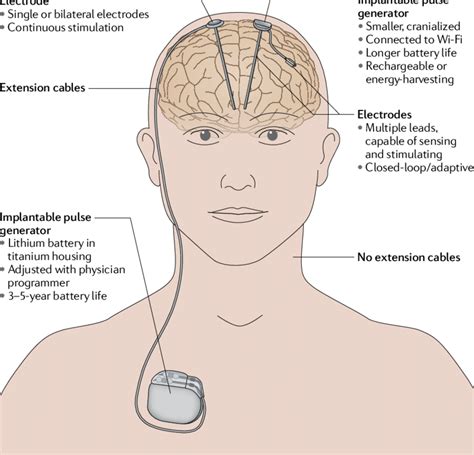 deep brain stimulation parkinson's reviews